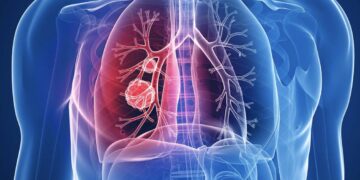 BioNtech nis testet klinike te njerëzit për vaksinën kundër kancerit të mushkërive