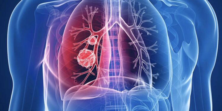 BioNtech nis testet klinike te njerëzit për vaksinën kundër kancerit të mushkërive