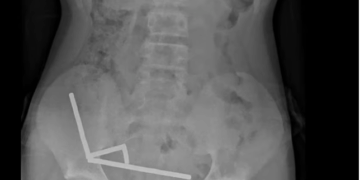 Gëlltiti 100 magnetë, mjekët i shpëtojnë jetën adoleshentit