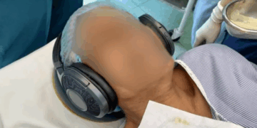 Pacientët me kufje në vesh nën anestezi, studimi: Zgjohen më shpejt pas operacionit kur dëgjojnë muzikë