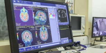 Analiza e gjakut zbulon ndryshimet në tru që lidhen me Alzheimerin