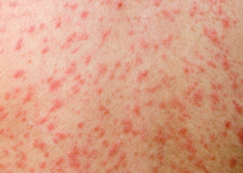 ISHP: Gjatë këtij viti u konfirmuan 18 raste të fruthit