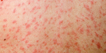 ISHP: Gjatë këtij viti u konfirmuan 18 raste të fruthit