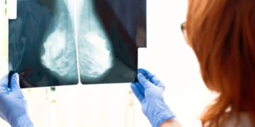 Revolucion në trajtimin e kancerit të gjirit, testi i ri përcakton trajtimin më efektiv për pacientin