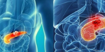 Shpresë e re për trajtimin e kancerit të pankreasit, terapia e re jep rezultate