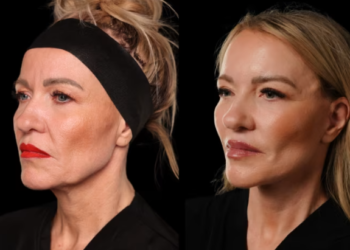 Pse operacionet plastike po preferohen të bëhen në dimër?