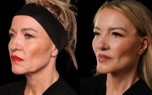 Pse operacionet plastike po preferohen të bëhen në dimër?