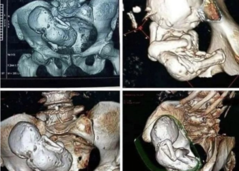 Skaneri zbulon fetus të kalcifikuar 30-vjeçar në trupin e një gruaje 73-vjeçare