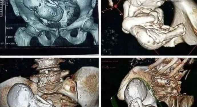 Skaneri zbulon fetus të kalcifikuar 30-vjeçar në trupin e një gruaje 73-vjeçare