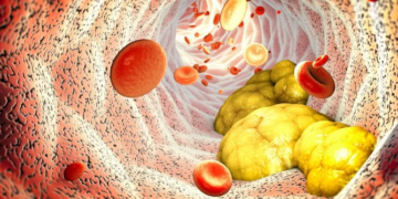 Studimet sfidojnë mitin, kolesteroli i lartë ndikon në jetëgjatësinë e të moshuarve