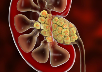 Zbulimi suprizues, si formohen gurët në veshka