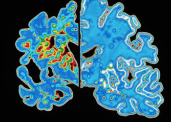 Testi i gjakut parashikon fillimin e simptomave të Alzheimerit shumë vite përpara