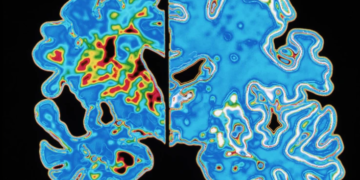 Testi i gjakut parashikon fillimin e simptomave të Alzheimerit shumë vite përpara