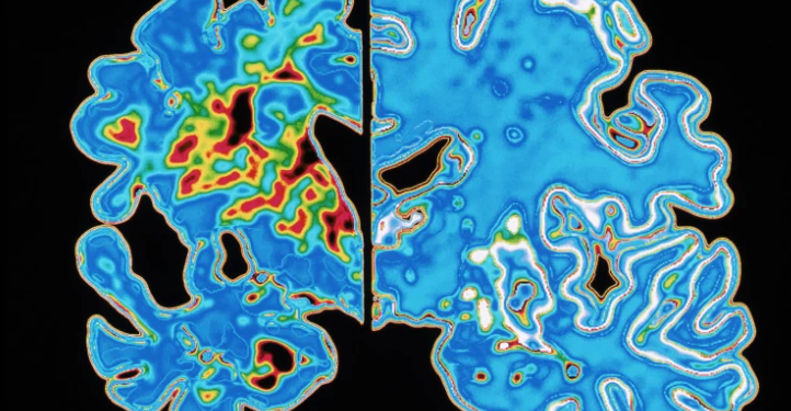 Testi i gjakut parashikon fillimin e simptomave të Alzheimerit shumë vite përpara