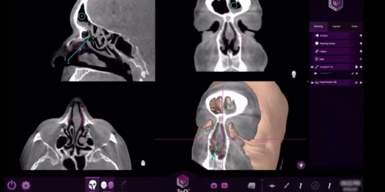 Inteligjenca Artificiale hyn në sallën e operacionit, por shtohen shqetësimet për sigurinë