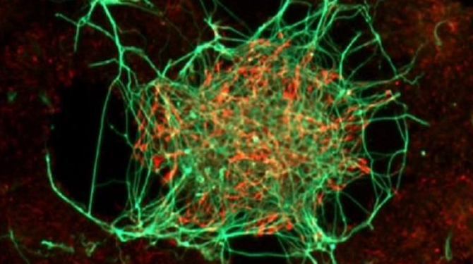 Miratohet trajtimi i parë në botë me qeliza staminale për Parkinsonin