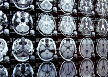 Shkencëtarët alarmohen pas zbulimit të mikroplastikës në trurin e njeriut