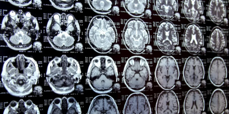 Shkencëtarët alarmohen pas zbulimit të mikroplastikës në trurin e njeriut