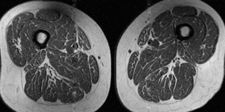 Ushqimet e përpunuara po i shndërrojnë kofshët e njeriut në “biftekë të yndyrshëm”