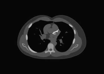 Një test i thjeshtë 10 minutësh po ndryshon mënyrën si vlerësohet rreziku për zemrën