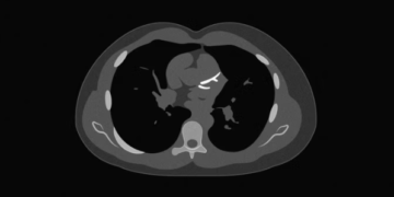 Një test i thjeshtë 10 minutësh po ndryshon mënyrën si vlerësohet rreziku për zemrën