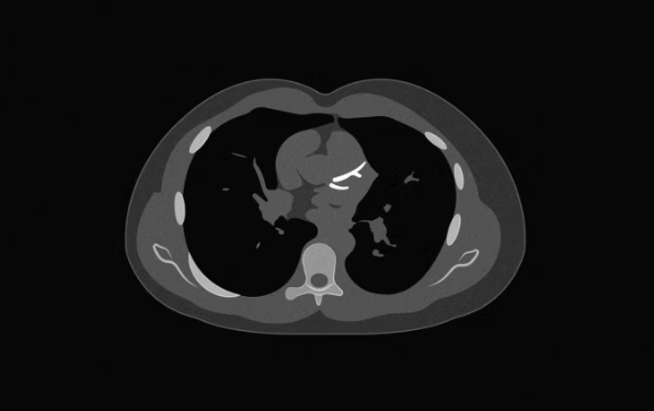 Një test i thjeshtë 10 minutësh po ndryshon mënyrën si vlerësohet rreziku për zemrën