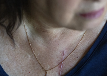 Zëvendësimi i valvulës pa operacion, mjekët në pikëpyetje për efektivitetin e metodës së re