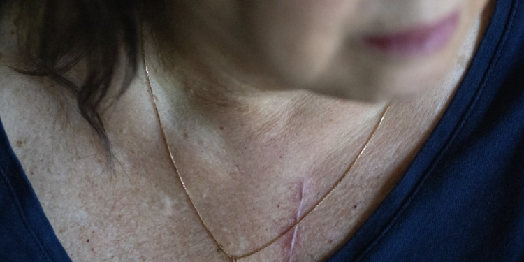 Zëvendësimi i valvulës pa operacion, mjekët në pikëpyetje për efektivitetin e metodës së re