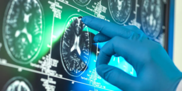 Ilaçet “revolucionare” për Alzheimerin vihen në pikëpyetje