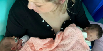 Trajtimi pioner shpëton binjaket identike nga një komplikacion i rrallë i shtatzënisë