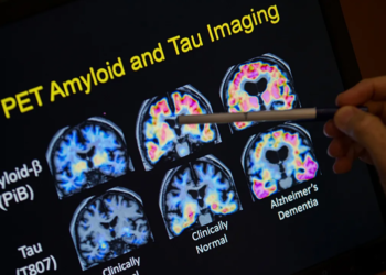 Zbulim i ri shkencor për Alzheimerin, një molekulë rikthen kujtesën te kafshët