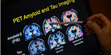 Zbulim i ri shkencor për Alzheimerin, një molekulë rikthen kujtesën te kafshët