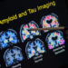 Zbulim i ri shkencor për Alzheimerin, një molekulë rikthen kujtesën te kafshët